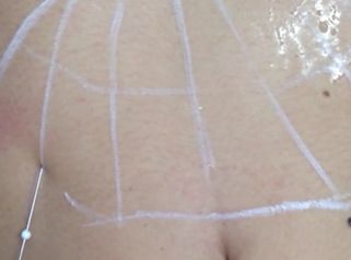 Hilos tensores en abdomen