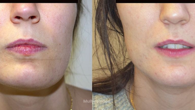 Tratamiento de Asimetría facial / Facial Asymmetry treatment