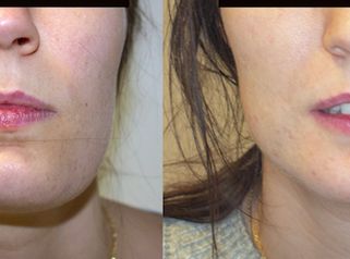 Tratamiento de Asimetría facial / Facial Asymmetry treatment