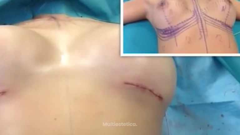 Así son las prótesis de mamas submusculares