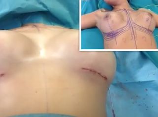 Así son las prótesis de mamas submusculares