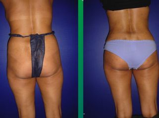 Lipofilling definitivo