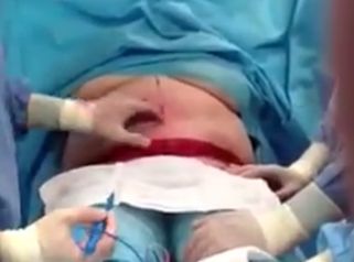 soluciona tu problema de obesidad mórbida