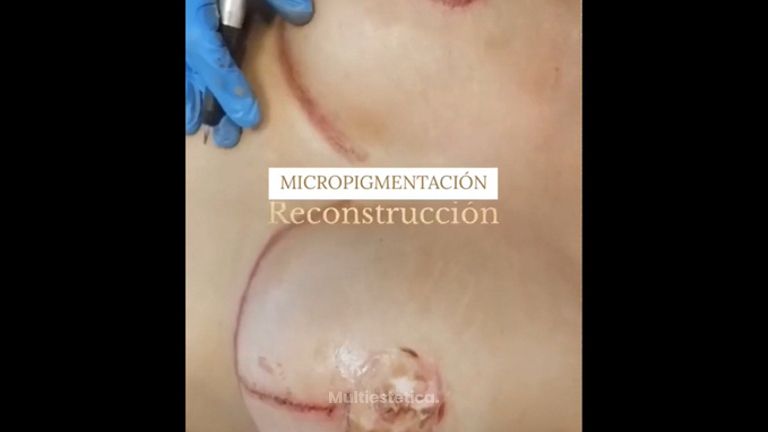 Micropigmentación en una reconstrucción mamaria - Aura Clínica