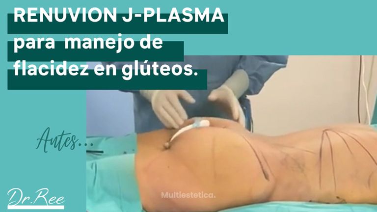 Lipo Vaser - Dr Ree