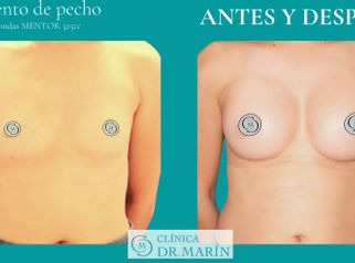 Aumento de pecho - Clínica Dr. Pascual Marín