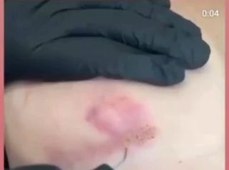 Tratamiento de Cicatrices