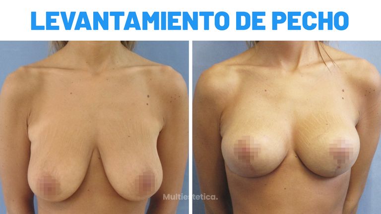 Mastopexia – Susana