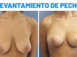 Mastopexia – Susana