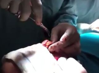 La reutilización de la grasa del paciente