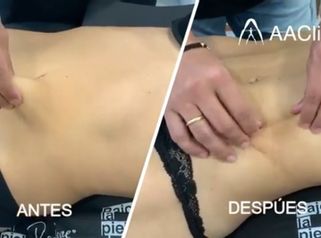 Criolipólisis - AA CLINIC