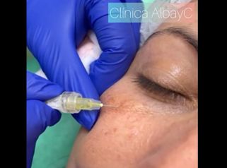 Eliminación de ojeras - ClinicaAlbayC