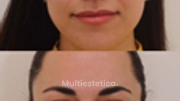 El tratamiento estrella para prevenir arrugas ✨