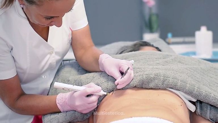 Eliminación eficaz de verrugas y puntos rubí