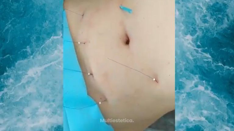 Hilos tensores