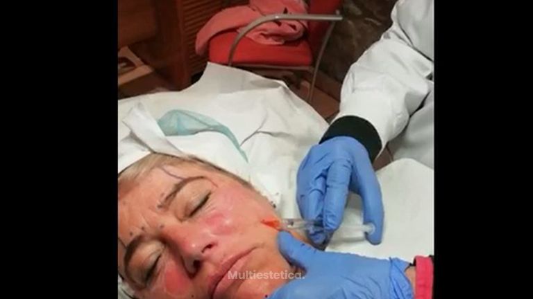 Rellenos Faciales