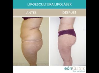 Lipoescultura