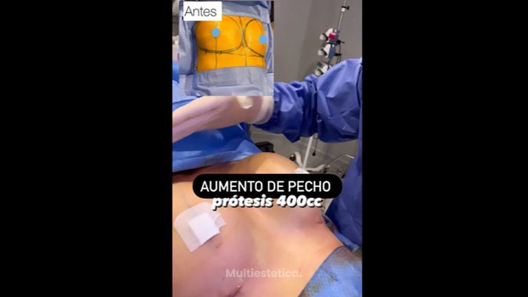Aumento de pecho - Clínica Dr. Jiménez