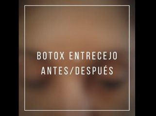 Toxina botulínica - Dr. Pau Bosacoma