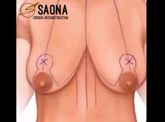 Mastopexia - Saona Clínicas De Estética
