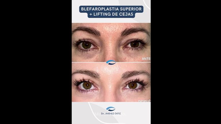 Blefaroplastia - Dr. Jiménez Ortiz