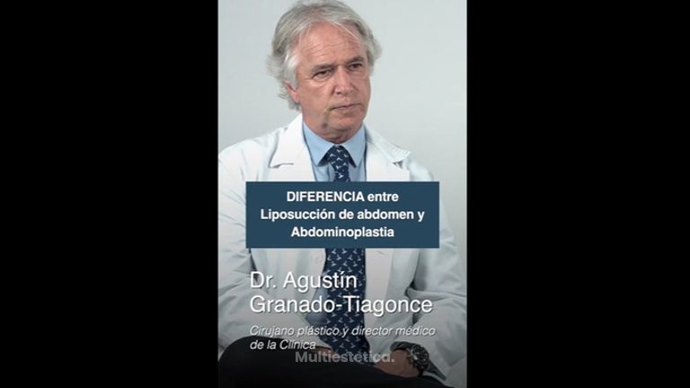 Diferencia entre liposucción abdominal y abdominoplastia - Clínica Granado Tiagonce