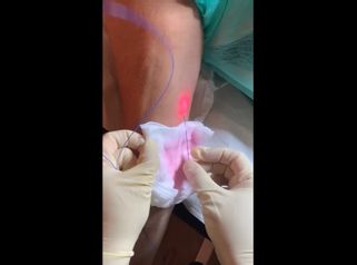 Endolift - Clínicas Dra. Matas