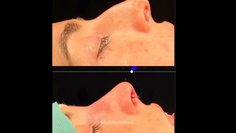 Rinoplastia (simulación y resultado real superpuestos)