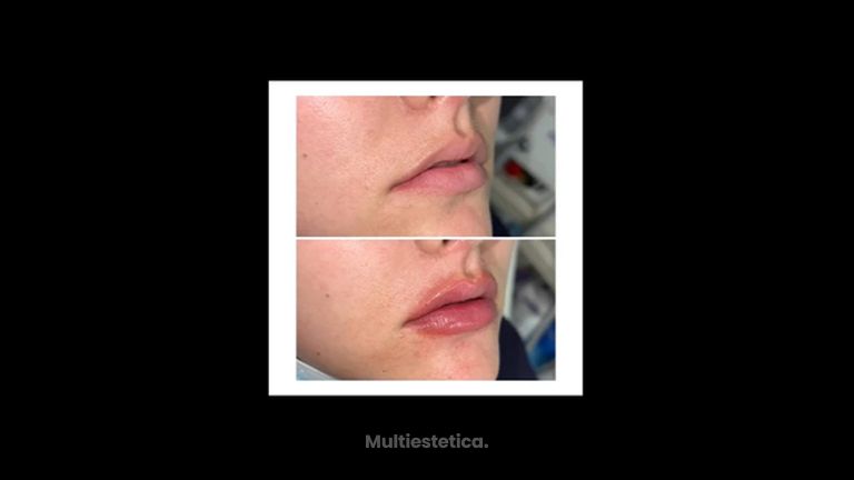 Aumento de labios - Dr. Jiménez Ortiz