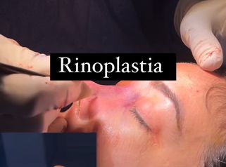 Rinoplastia - Clínica Dr. Jiménez