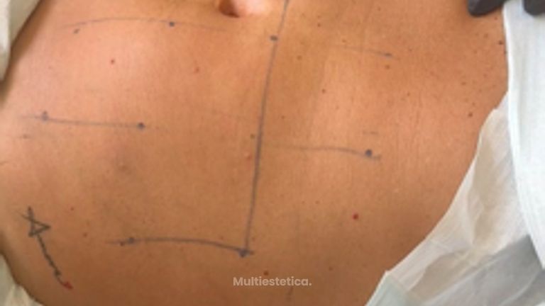 Criolipólisis - Clínicas Dra. Matas