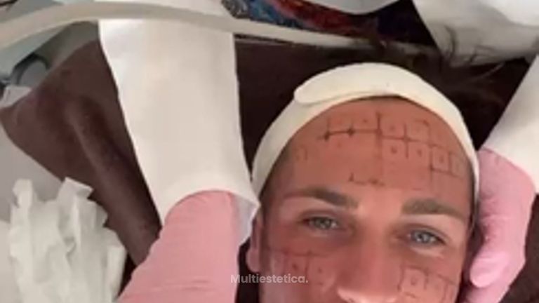 Thermage FLX facial y cuello