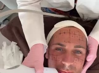 Thermage FLX facial y cuello