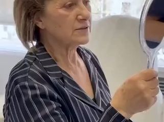 ✨María Dolores está encantada con el resultado de su cirugía👁️Su mirada luce despejada y descansada