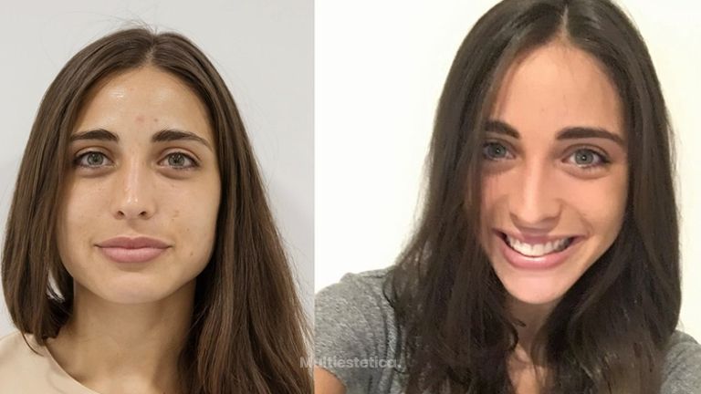 Revitalización facial con vitaminas