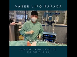 Liposucción de papada - AA CLINIC