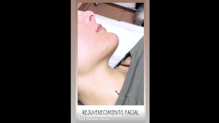 Rejuvenecimiento facial - Dra. Carmen Torrejón