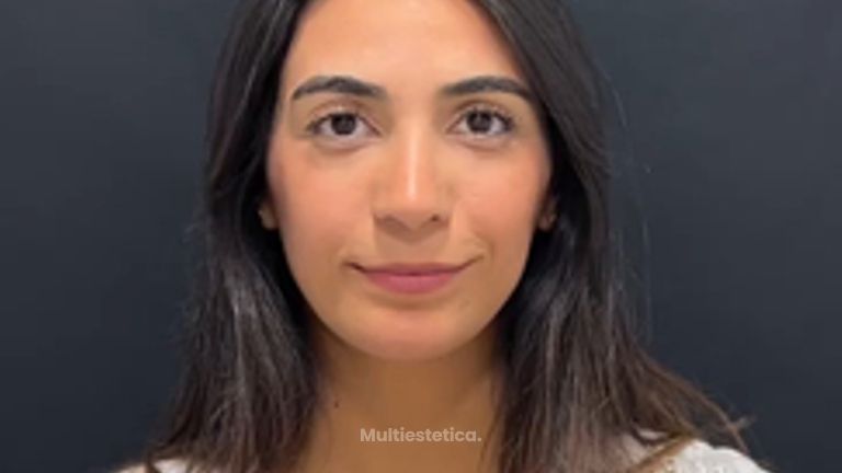 Rinoplastia - Clinica Silvia Roson