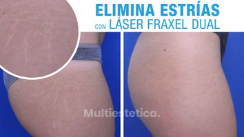 Eliminar estrías con láser – Alicia