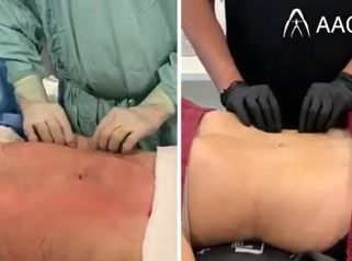 Liposucción - AA CLINIC