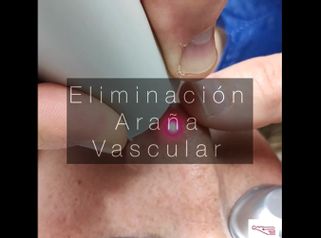 Láser Vascular - Clínica De Medicina Estética Córdoba
