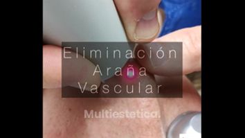 Láser Vascular - Clínica De Medicina Estética Córdoba