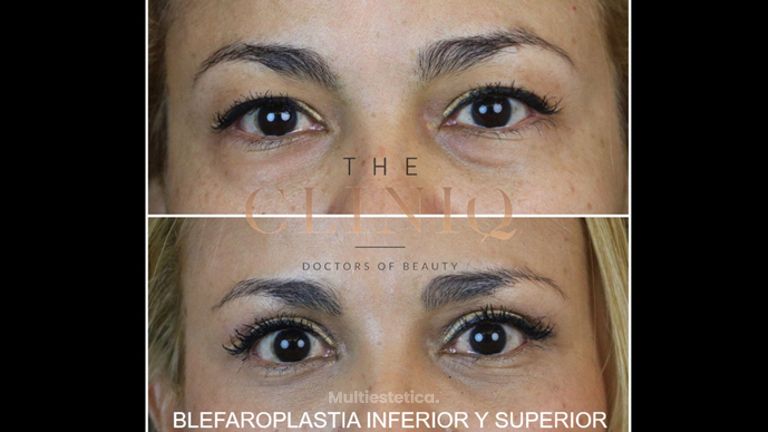 Blefaroplastia inferior y superior / Lipofilling - The CLINIQ