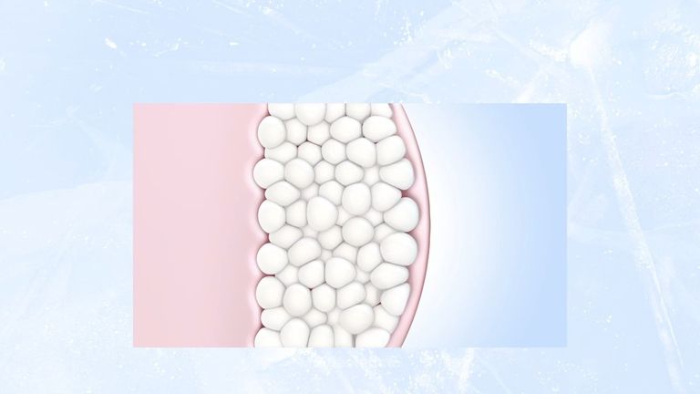 ¿Cómo funciona CoolSculpting? - Porcuna&DeBenito