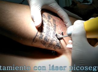 Eliminación de tatuajes - Clínica Openderma