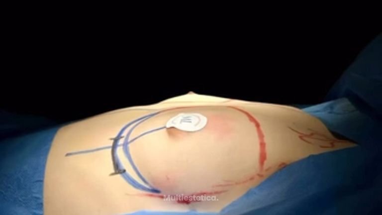 Aumento de pecho - Clínica Dr. Millán Longo y Asociados