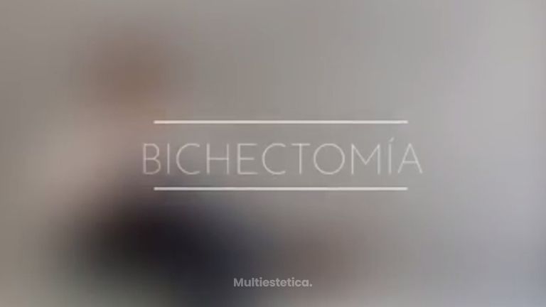Bichectomía