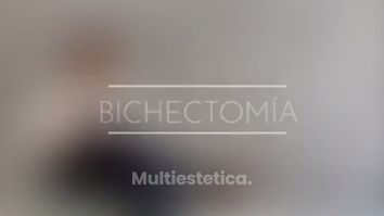 Bichectomía