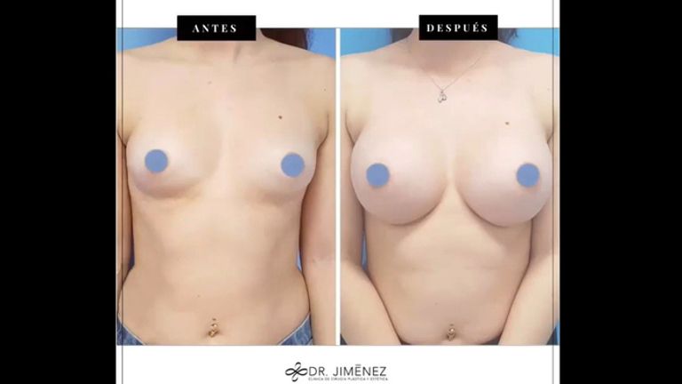 Aumento de pecho - Clínica Dr. Jiménez