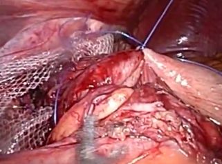 Reparación de una hernia